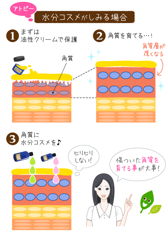 アトピーで基礎化粧品がしみる場合のスキンケア