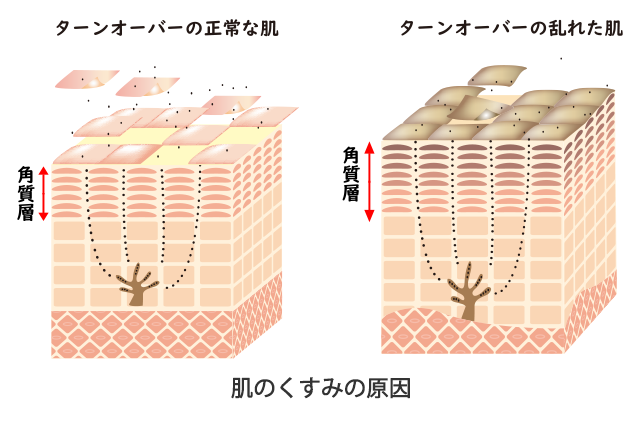 ターンオーバーの乱れが肌のくすみの原因に