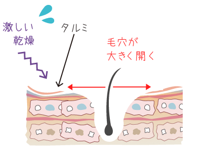 ハリを失い弛んで毛穴が極端に開いたお肌