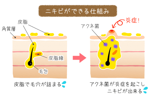 ニキビが出来る仕組み