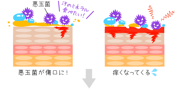 汗のミネラル分と増殖した悪玉菌で痒みが発生