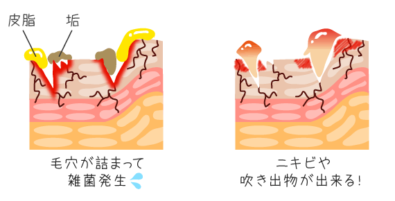 開いた毛穴で雑菌発生