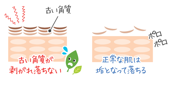 古い角質が剥がれ落ちなくなった状態。