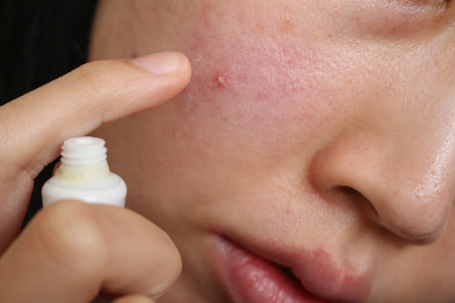 角質肥厚で毛穴がぶつぶつしたりニキビになりやすいって本当?